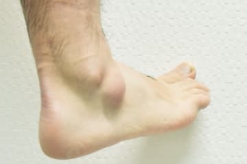 ガングリオンは負担のかかっている関節に出来る事が多い